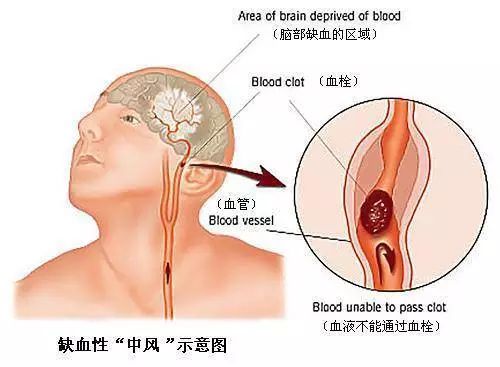 用美国的黑科技解救中国的脑梗塞